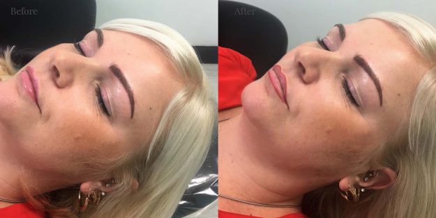 Client 1 After Fine line lip contouring