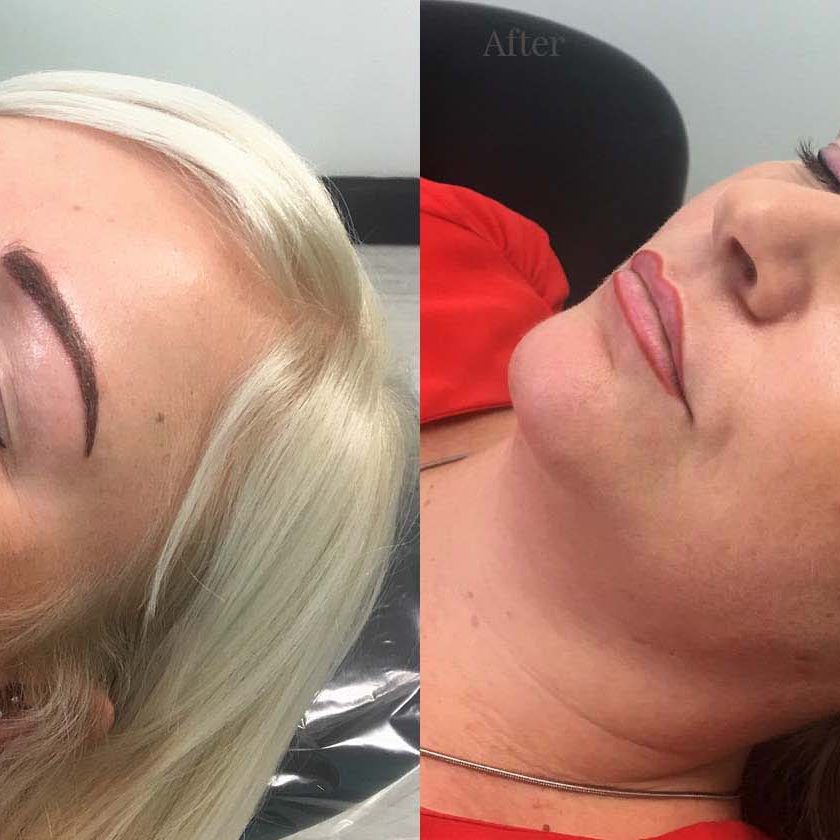 Client 1 After Fine line lip contouring