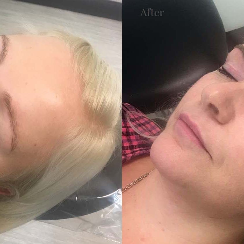 Client 1 Eyebrow after
