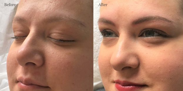 Elma before & after Eyebrows 1