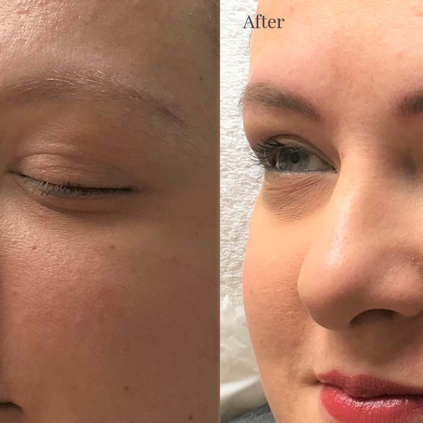 Elma before & after Eyebrows 1