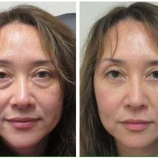 1-Plasma-Pen-Treatment-Before-And-After-Lower-Eyelids-Infraorbital 1-Plasma-Pen-Treatment-Before-And-After-Lower-Eyelids-Infraorbital