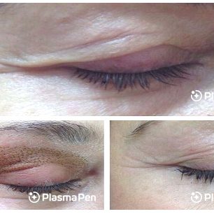 10-Plasma-Pen-Treatment-Before-And-After-Upper-And-Lower-Eyelids-Blepharoplasty 10-Plasma-Pen-Treatment-Before-And-After-Upper-And-Lower-Eyelids-Blepharoplasty