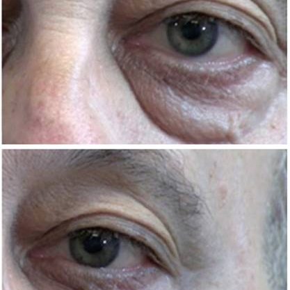 11-Plasma-Pen-Treatment-Before-And-After-Upper-Lower-Eyelids-Infraorbital 11-Plasma-Pen-Treatment-Before-And-After-Upper-Lower-Eyelids-Infraorbital
