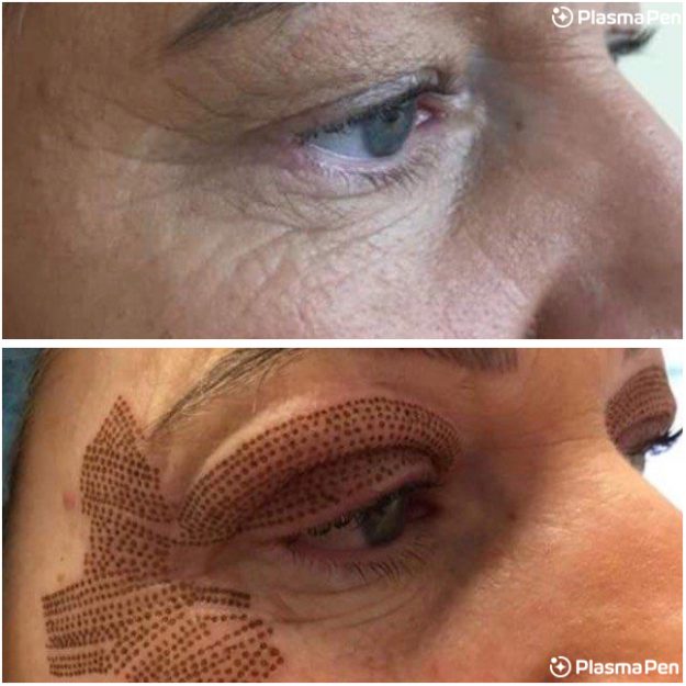 12-Plasma-Pen-Treatment-Before-And-Immediately-After-Crows-Feet-And-Upper-Eyelids