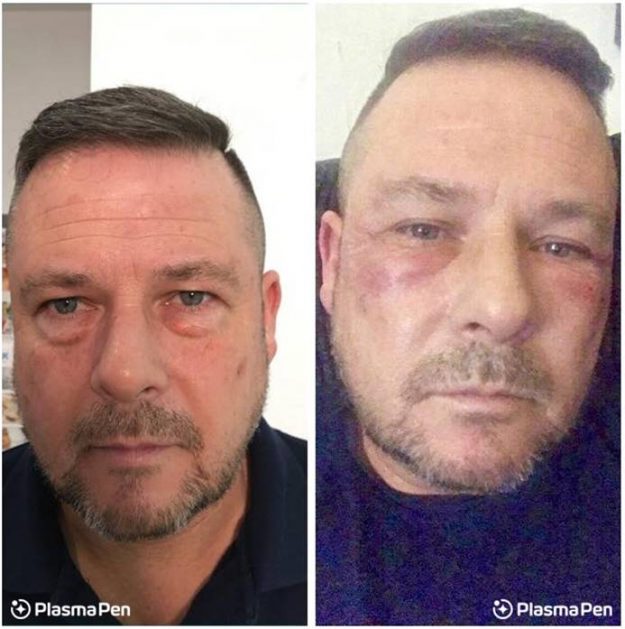 2-Plasma-Pen-Treatment-Before-And-After-Lower-Eyelids-Infraorbital