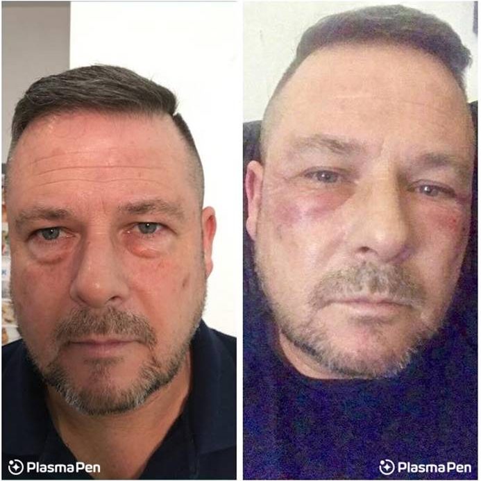 2-Plasma-Pen-Treatment-Before-And-After-Lower-Eyelids-Infraorbital 2-Plasma-Pen-Treatment-Before-And-After-Lower-Eyelids-Infraorbital