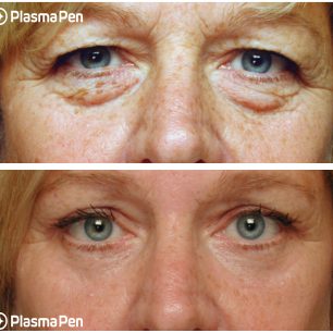 6-Plasma-Pen-Treatment-Before-And-After-Upper-And-Lower-Eyelids-Blepharoplasty 6-Plasma-Pen-Treatment-Before-And-After-Upper-And-Lower-Eyelids-Blepharoplasty