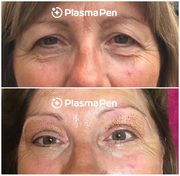 7_Plasma-Pen-Treatment-Before-And-Immediately-After-Upper-And-Lower-Eyelids-Blepharoplasty