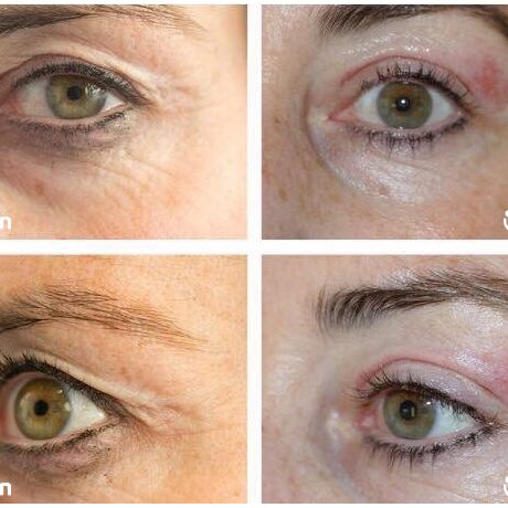 6-Plasma-Pen-Treatment-Before-And-After-Upper-And-Lower-Eyelids