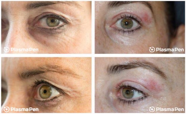 8-Plasma-Pen-Treatment-Before-And-After-Upper-And-Lower-Eyelids-Blepharoplasty