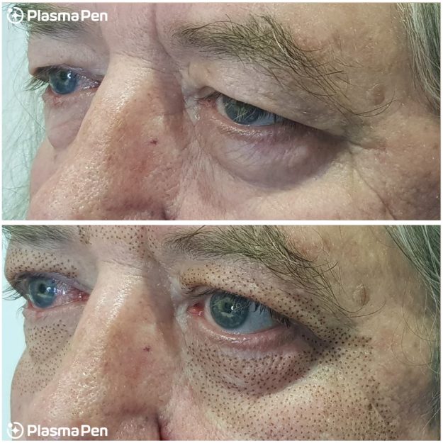 9-Plasma-Pen-Treatment-Before-And-Immediately-After-Upper-And-Lower-Eyelids-Blepharoplasty