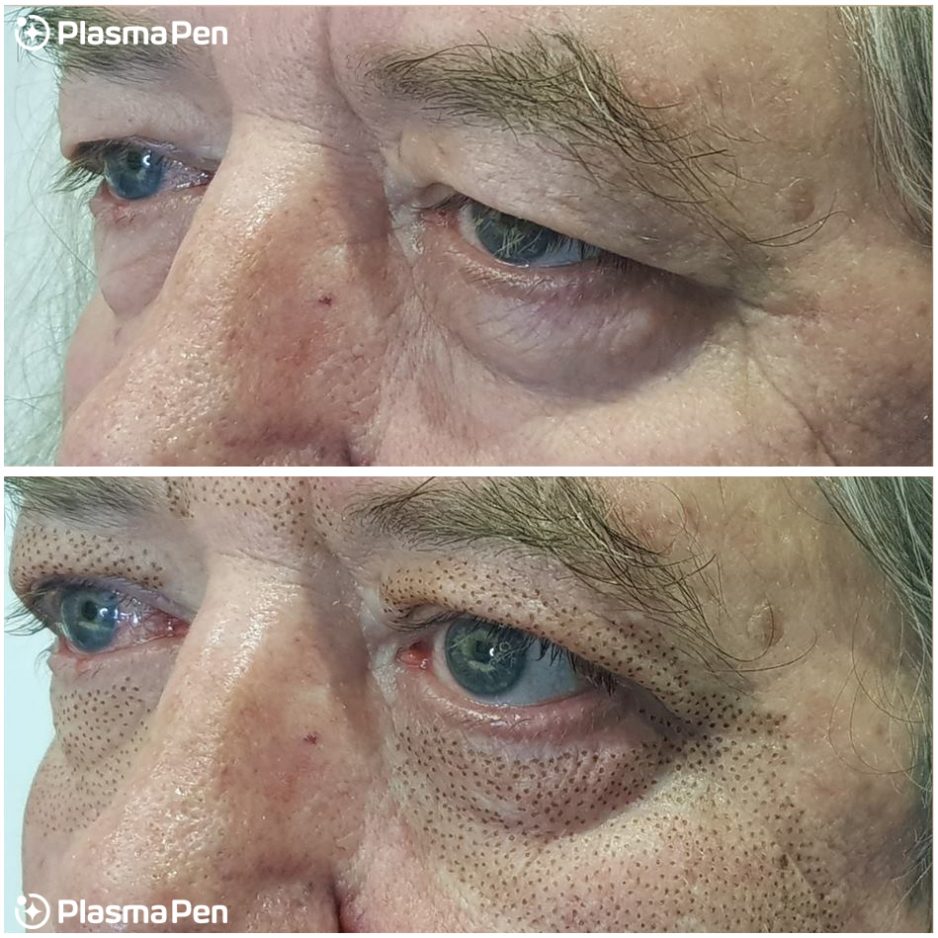 9-Plasma-Pen-Treatment-Before-And-Immediately-After-Upper-And-Lower-Eyelids-Blepharoplasty